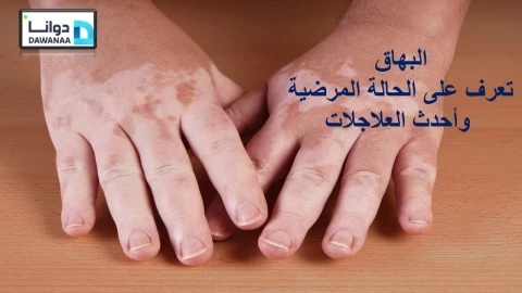 مرض البهاق " Vitiligo "الأنواع وطرق  العلاج .